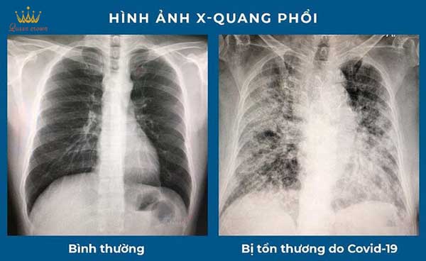 #Những Ảnh Hưởng Hậu Covid Mà Nhiều Người Chưa Biết