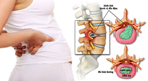 #5 Cách Chữa Thoát Vị Đĩa Đệm Tại Nhà Và Những Điều Nên Làm