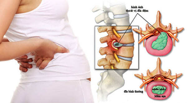 cách chữa thoát vị đĩa đệm tại nhà