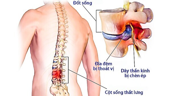 cách chữa thoát vị đĩa đệm tại nhà