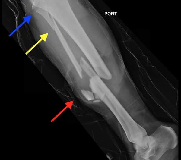 cách tập đi sau khi tháo bột