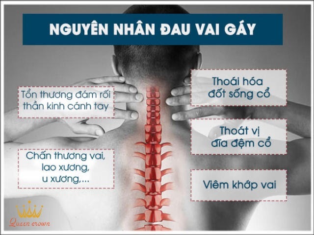 nguyên nhân đau mỏi vai gáy