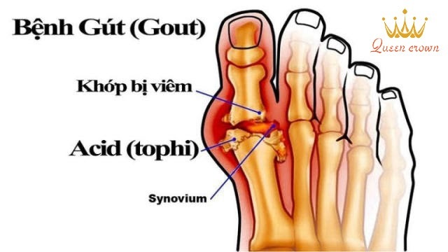 cách trị nhức mỏi tay chân tại nhà