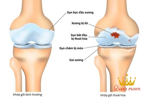 đau nhức xương khớp ở người trẻ