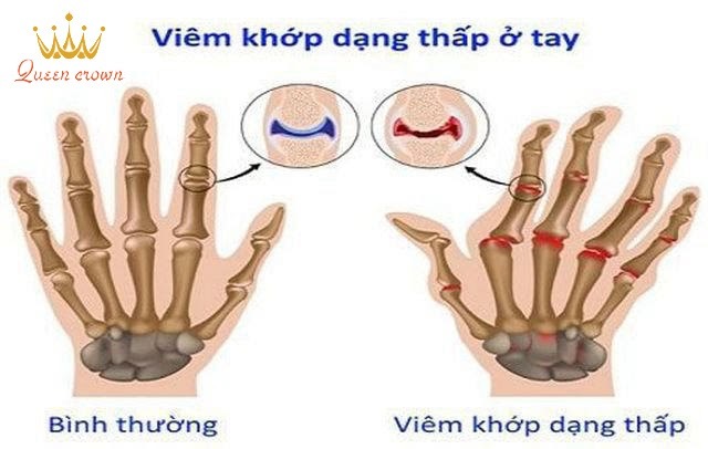 đau nhức xương khớp ở người trẻ