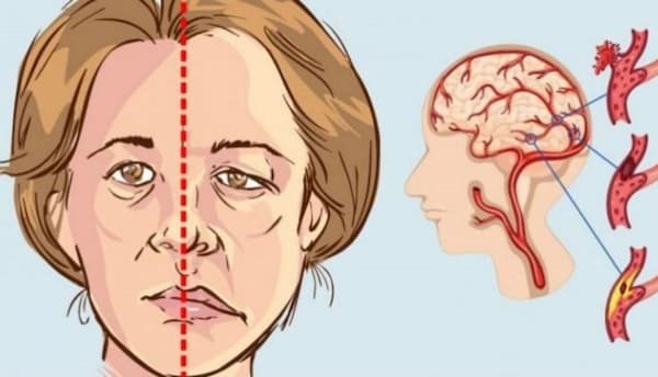 đứt mạch máu não có cứu được không