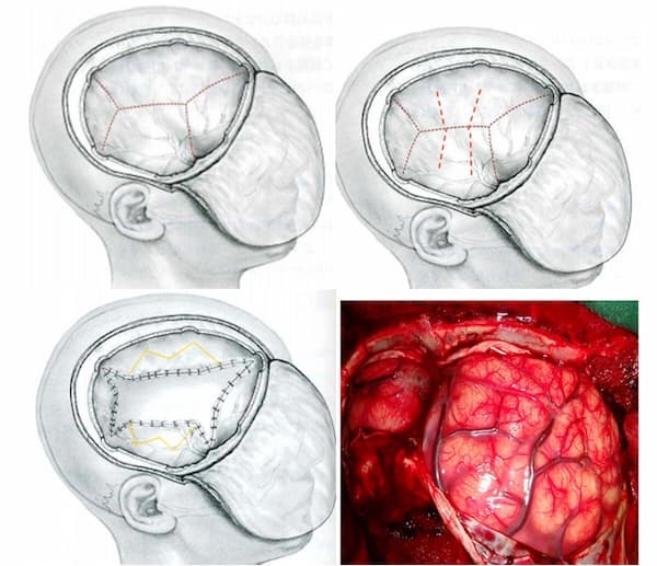 đứt mạch máu não có cứu được không