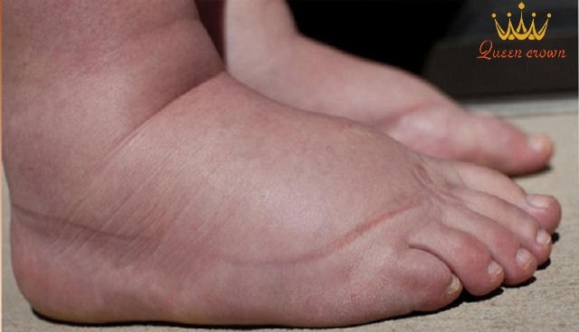 cách giảm phù chân ở người già