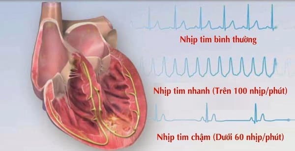nhịp tim chậm