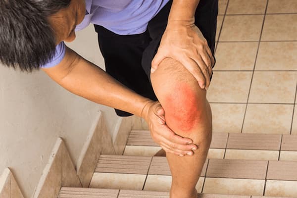 nhức khớp gối
