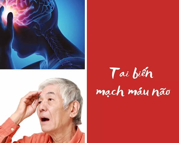tai biến mạch máu não