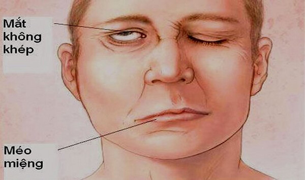 tai biến mạch máu não