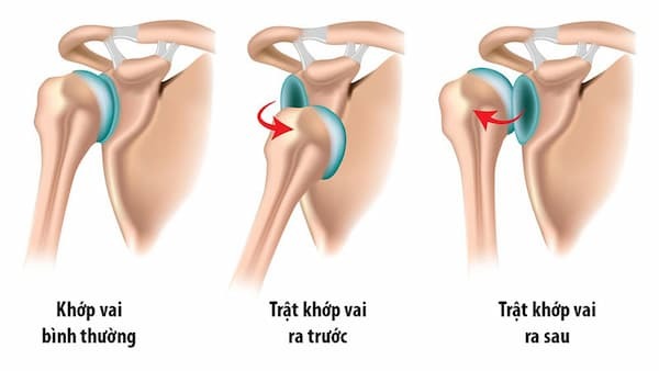 trật khớp