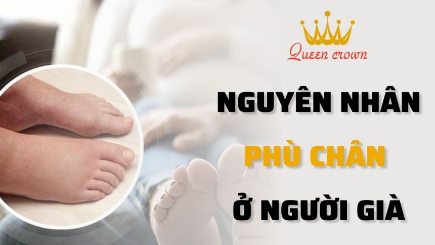 Nguyên nhân bị phù chân ở người già? Cách điều trị thế nào?